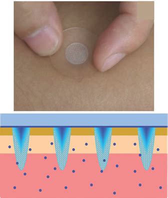 Phasetransition Microneedle Patches For Efficient And Accurate