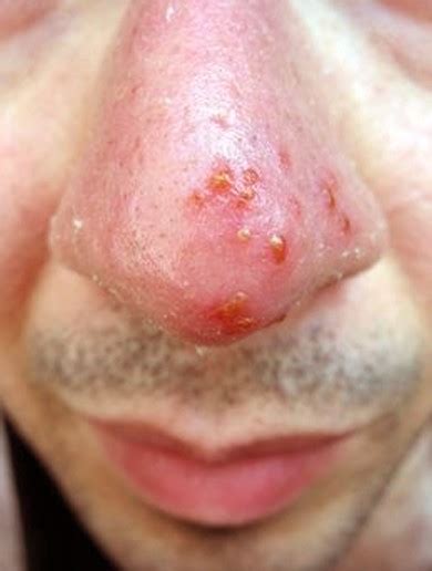 Fever Blisters Pictures Symptoms Causes Contagious Treatment