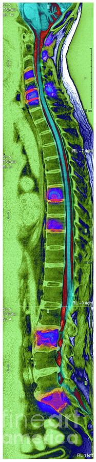 Bone Cancer 5 By Simon Frasernewcastle Hospitals Nhs Trustscience Photo Library