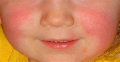 Scarlet Fever Symptoms Every Parents Needs To Know About