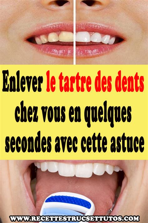 Enlever Le Tartre Des Dents Chez Vous En Quelques Secondes Avec Cette