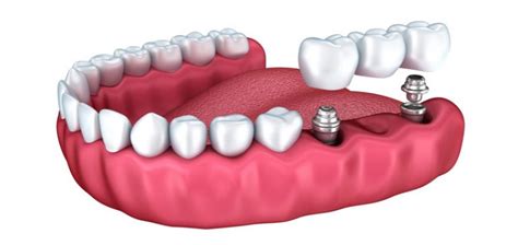 Implantes Carga Imediata Cl Nica G Implantes