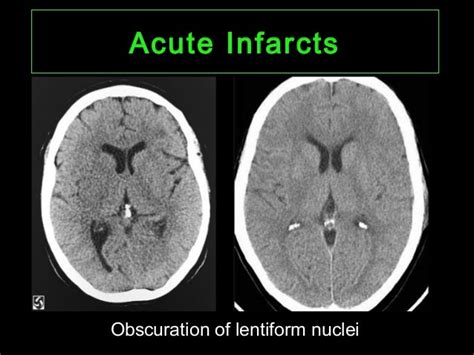 Ct Imaging Of Cerebral Ischemia And Infarction