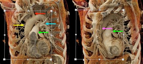 Chest Learning Modules Ct Scanning