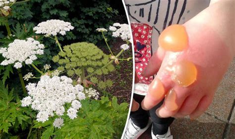 Hogweed Warning Poisonous Plant Sweeps Across Uk Uk News Uk