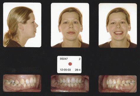 Category 2 Skeletal Class Ii Malocclusion With Retrognathic Mandible And Hyperdivergent Pattern