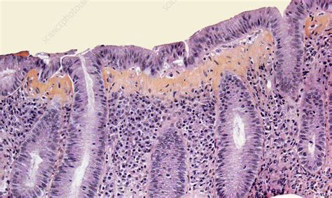 Collagenous Colitis Light Micrograph Stock Image C044 3108 Science Photo Library