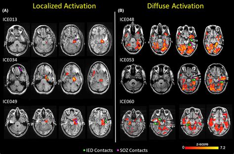 Mesial Temporal Lobe Spiking Reveals Distinct Patterns Of Blood Oxygen