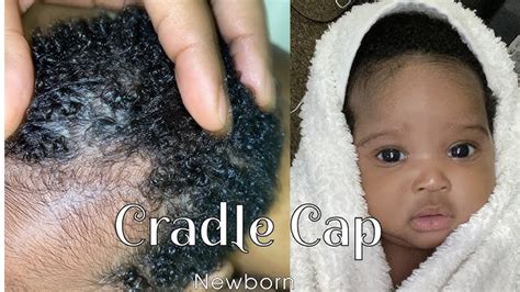 Cradle Cap In Adults