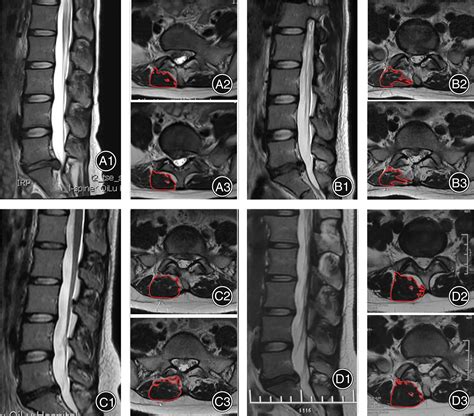 Comparison Of Clinical Outcomes And Muscle Invasiveness Between