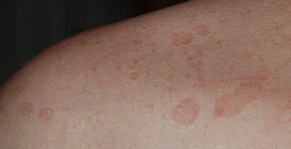 Pityriasis Versicolor Da Vinci Clinic