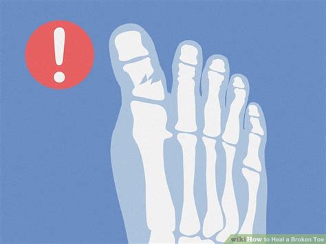 How To Heal A Broken Toe Steps With Pictures Wikihow