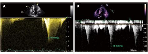 Transthoracic Echocardiogram Continuous Doppler A Transthoracic