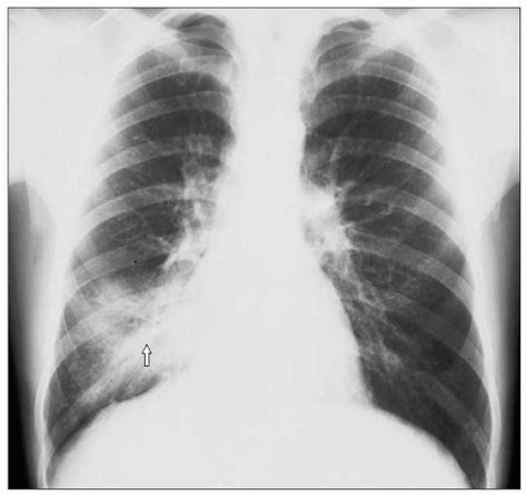 Community Acquired Pneumonia Thoracic Key