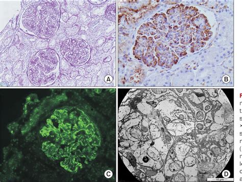 Figure 1 From Membranoproliferative Glomerulonephritis In A Patient With Chronic Brucellosis