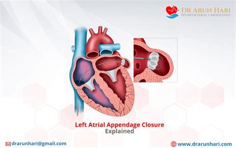 Left Atrial Appendage Closure Explained Dr Arun Hari