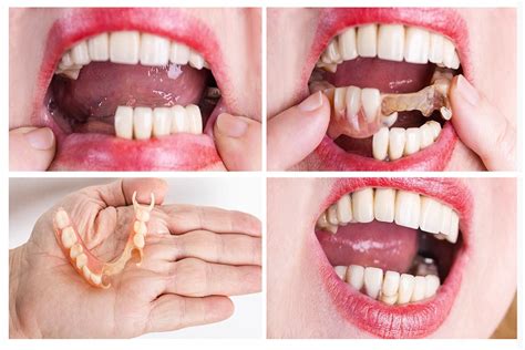 Semi Flexible Dentures Overview Benefits