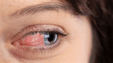 Ocular Rosacea Symptoms Causes And Treatment Gladskin