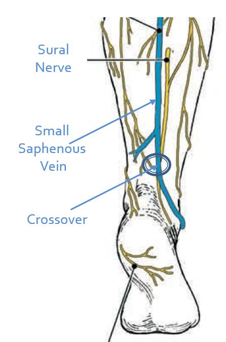 Sural Nerve