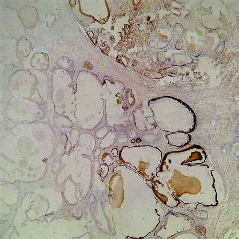 Prostatic Adenocarcinoma Ihc Showing Negative Staining Pattern Of Ema Download Scientific