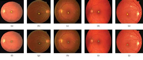 Figure 1 from Detection of macula and fovea for disease analysis in ...