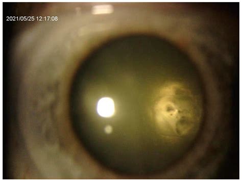 Cataract Extraction After Inadvertent Nd Yag Laser Capsulotomy In A