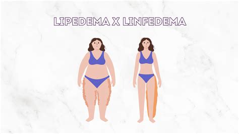 Lipedema E Linfedema Quais As Diferen As