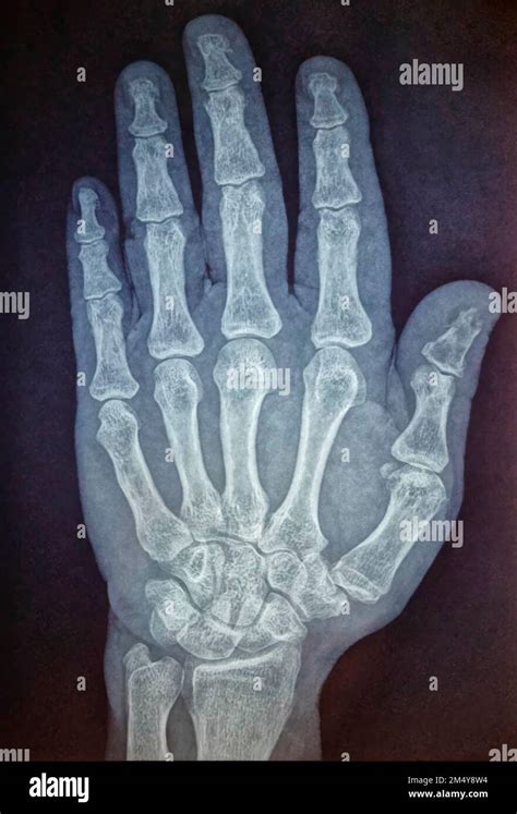 Radiografía De La Mano Humana Radiografía De Los Huesos De La Mano