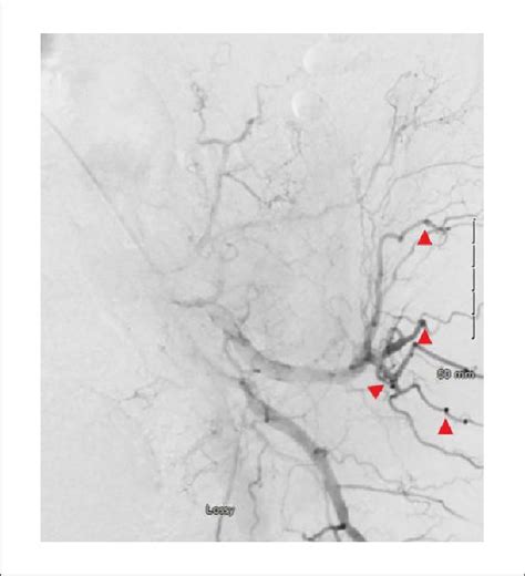 Left Renal Artery Arteriogram Showing Multiple Aneurysms Download Scientific Diagram