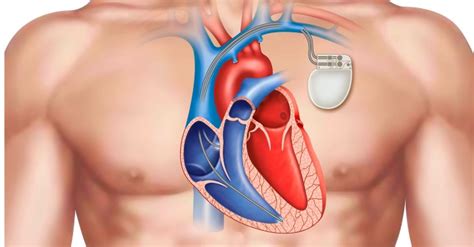 Pacemaker Implantation Starts At Anantnags Hospital The Legitimate