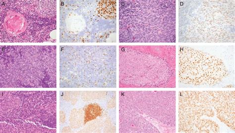 PAX8 Expression In Non Neoplastic And Neoplastic Thymic Tissues A And