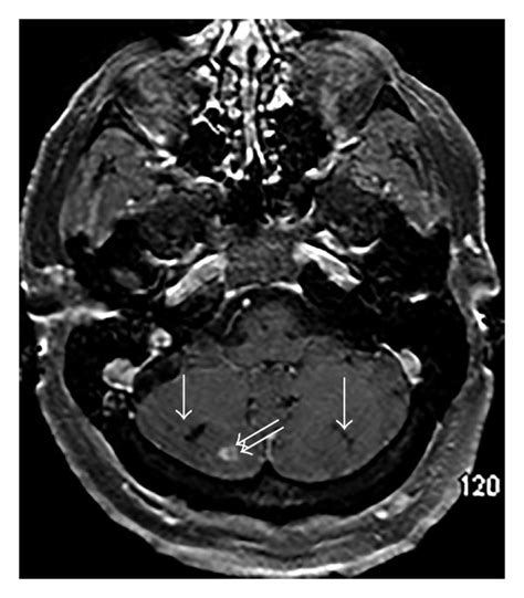 A Coronal Postcontrast T Weighted Magnetic Resonance Mr Image