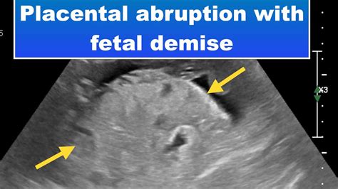 Placental Abruption With Fetal Demise I Ultrasound YouTube