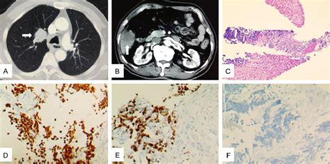 Figure From Synchronous Primary Lung Cancer And Hepatic Cancer Versus