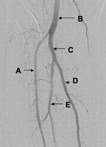 Angiogram Of Right Lower Leg The Bmj