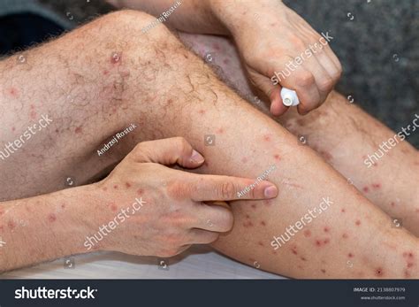 Scabies Rash On Arms