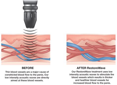 Acoustic Wave Therapy - Precise Men's Medical