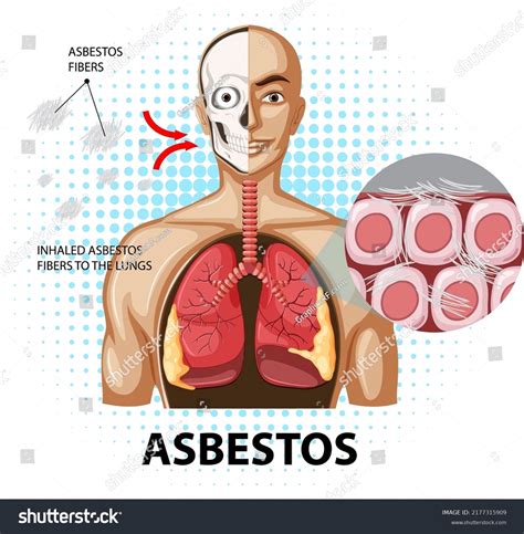 Diagram Showing Asbestosis In Lungs Illustration Royalty Free Stock