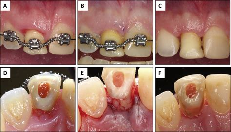 Combined Orthodontic Surgical And Restorative Approach To Treat A Complicated Crown Root