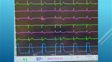 7. Pericardiocentesis - Confirming Location - YouTube