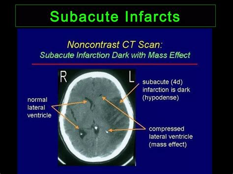 Ct Imaging Of Cerebral Ischemia And Infarction Ppt