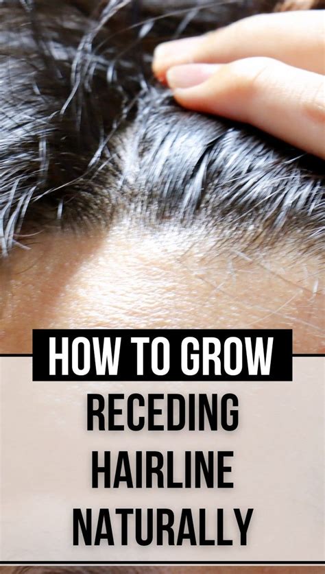 How To Grow Receding Hairline Back Naturally A Comprehensive Guide