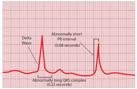 delta wave ecg