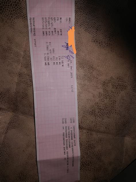Расшифровка ЭКГ Расшифровать ЭКГ Авто ID: 07246 Желудочковый ритм : 84 ...