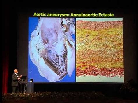 Video Congresso Patologia Dell Aorta Toracica Trattamento