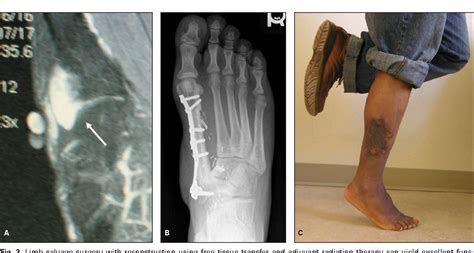 Figure From Soft Tissue Sarcoma Of The Foot Semantic Scholar