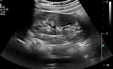 Abdominal Ultrasound Scan Ultrasound Scan