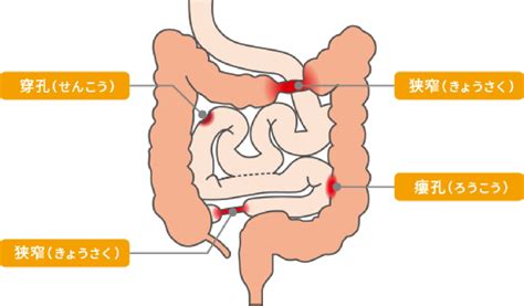 クローン病になるとどうなるの？ クローン病の基礎知識 クローン病 Ibd Life