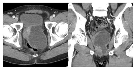 Medicina Free Full Text Rapid Recurrence Of Giant Multilocular Prostatic Cystadenoma After