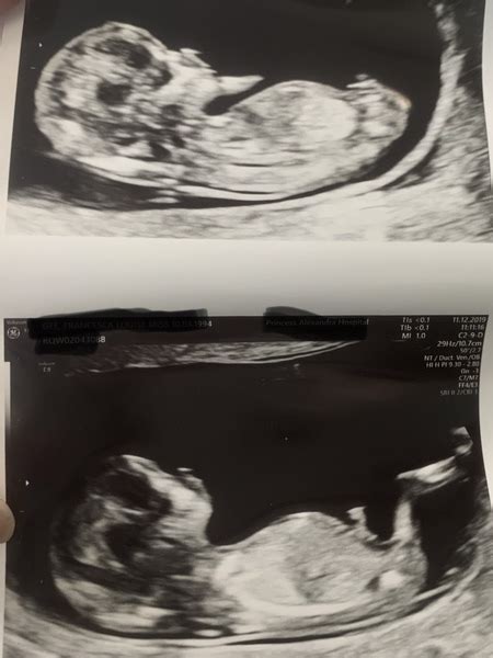 Just Had A 12 Week Scan Nub Skull Theory Guesses Please Mumsnet